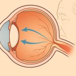 Glaucome