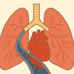 Embollie pulmonaire