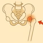Fracture col fémur
