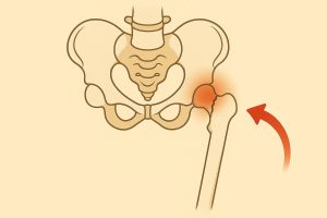 Fracture col fémur