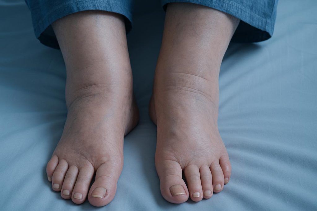 Pieds gonflés