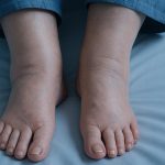 Pieds gonflés